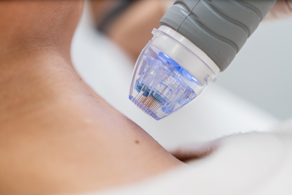 Cheap RF Microneedling Treatments in Gilbert AZ